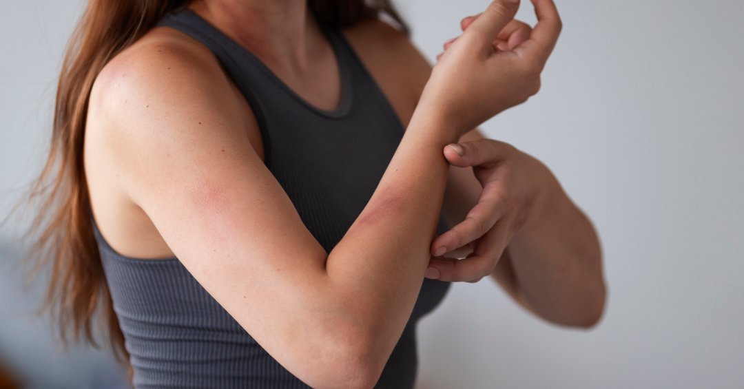 Alergia ao suor? Conheça a urticária colinér...