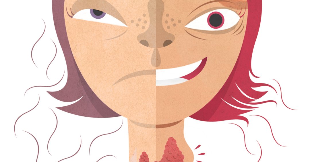 Bócio: Quais são os primeiros sinais do aume...