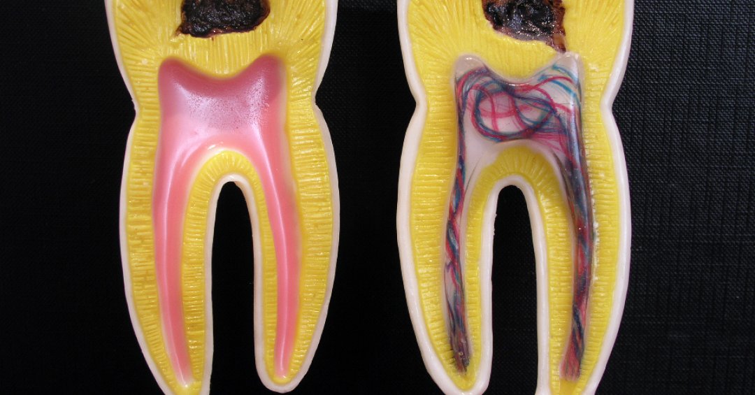 Cárie: o que é, quais são as causas e como t...