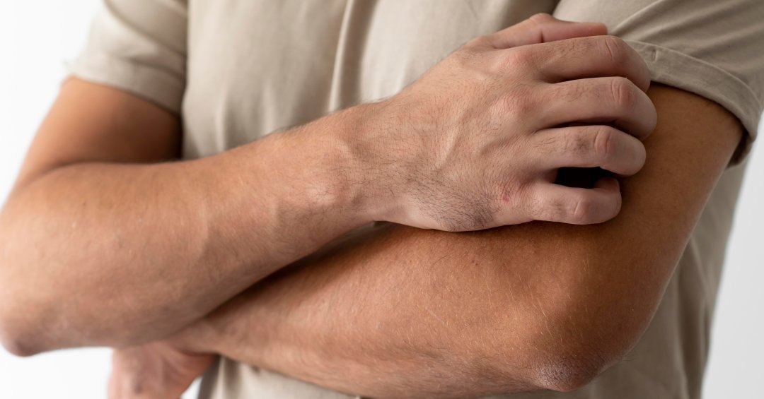 Como aliviar a coceira da dengue