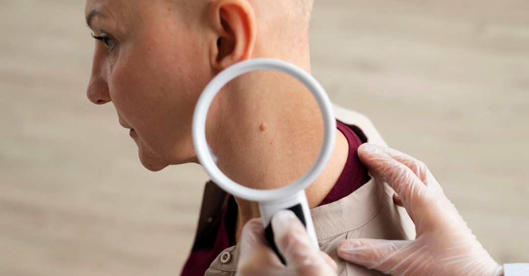 Como remover verrugas? Dá para tirar em casa?