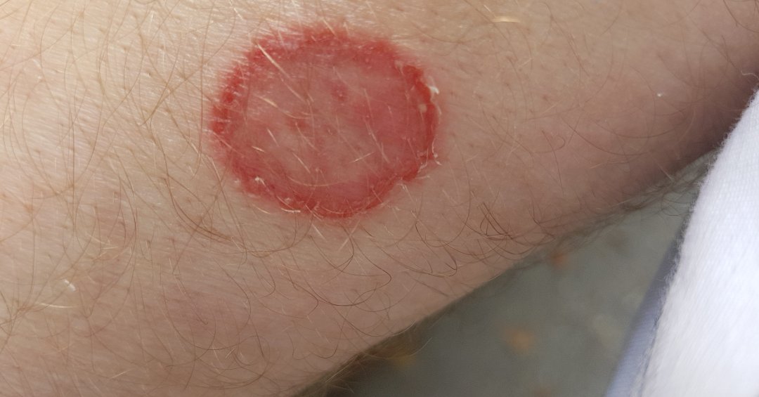 Dermatofitose: infecção causa coceira e verm...