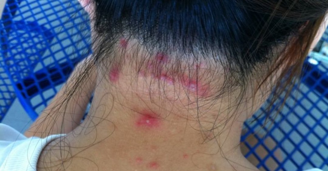 Foliculite capilar: como tratar a inflamação...