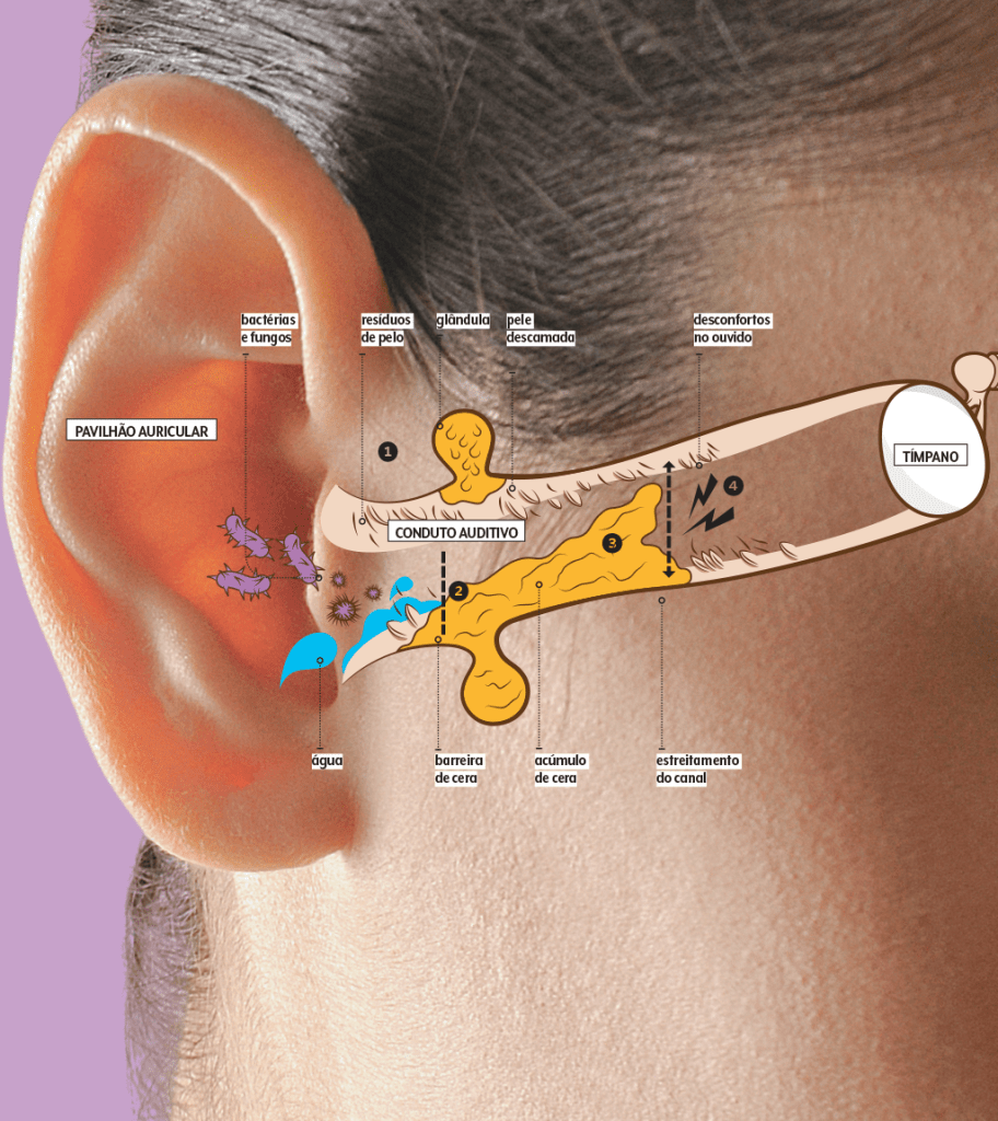 cera-de-ouvido-como-se-forma