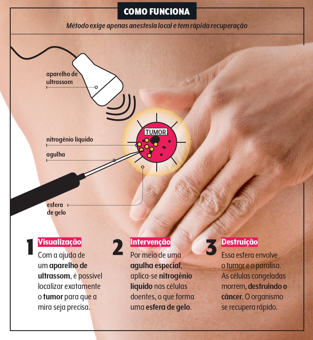 como-funciona-crioablacao