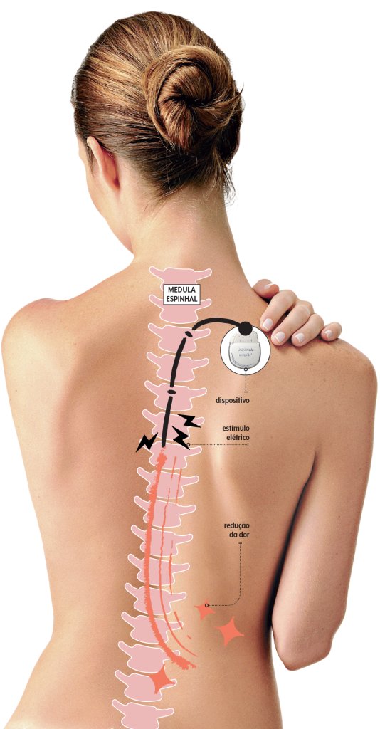 infografico-medula-dor-cronica