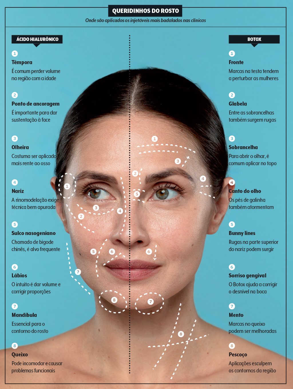 injetaveis-quadro-onde-aplicar-botox-AH