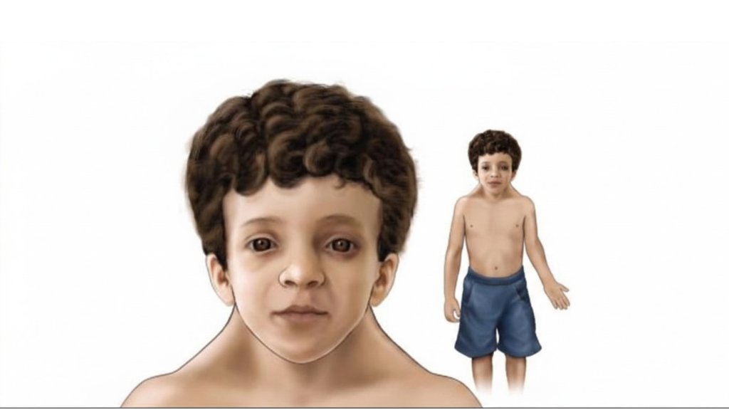 desenho representa criança com características comuns da síndrome de noonan
