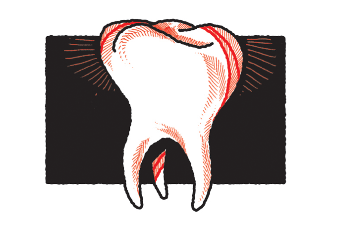 Após perda de dente, enxerto ósseo devolve capacidade de comer e sorrir