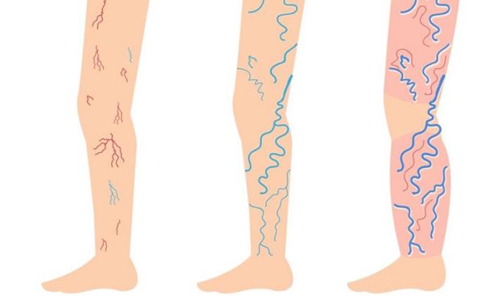 Para cada tipo de vasinho na perna é utilizada uma técnica de tratamento
